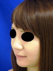 術後　１週間　右前斜位